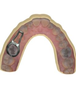 Custom CAD-designed space maintainer for children