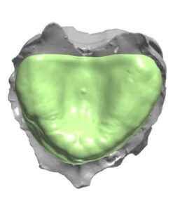 Partial denture base designed with advanced CAD software