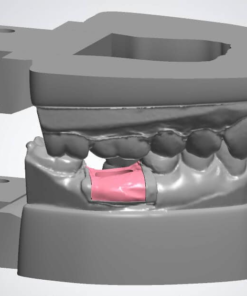 Implant Model - CAD Design