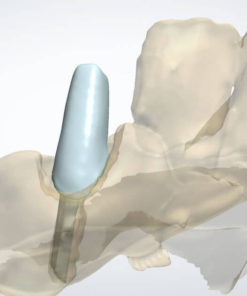 Digital Post & Core CAD design for dental restoration