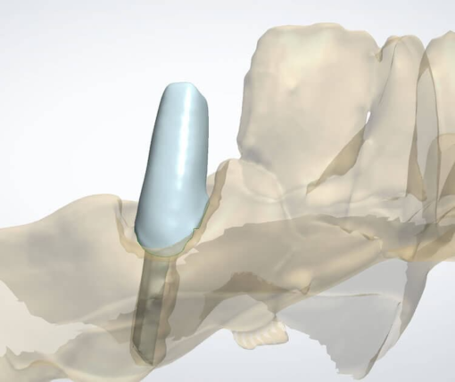 Post & Core CAD Design – Precise Digital Post and Core for Tooth ...