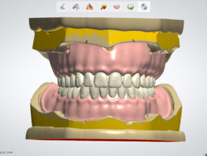 Professional full denture design using advanced CAD/CAM technology with 3Shape and Exocad software systems