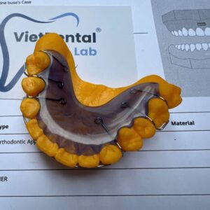 Hàm duy trì Hawley giúp giữ răng ổn định sau niềng răng.